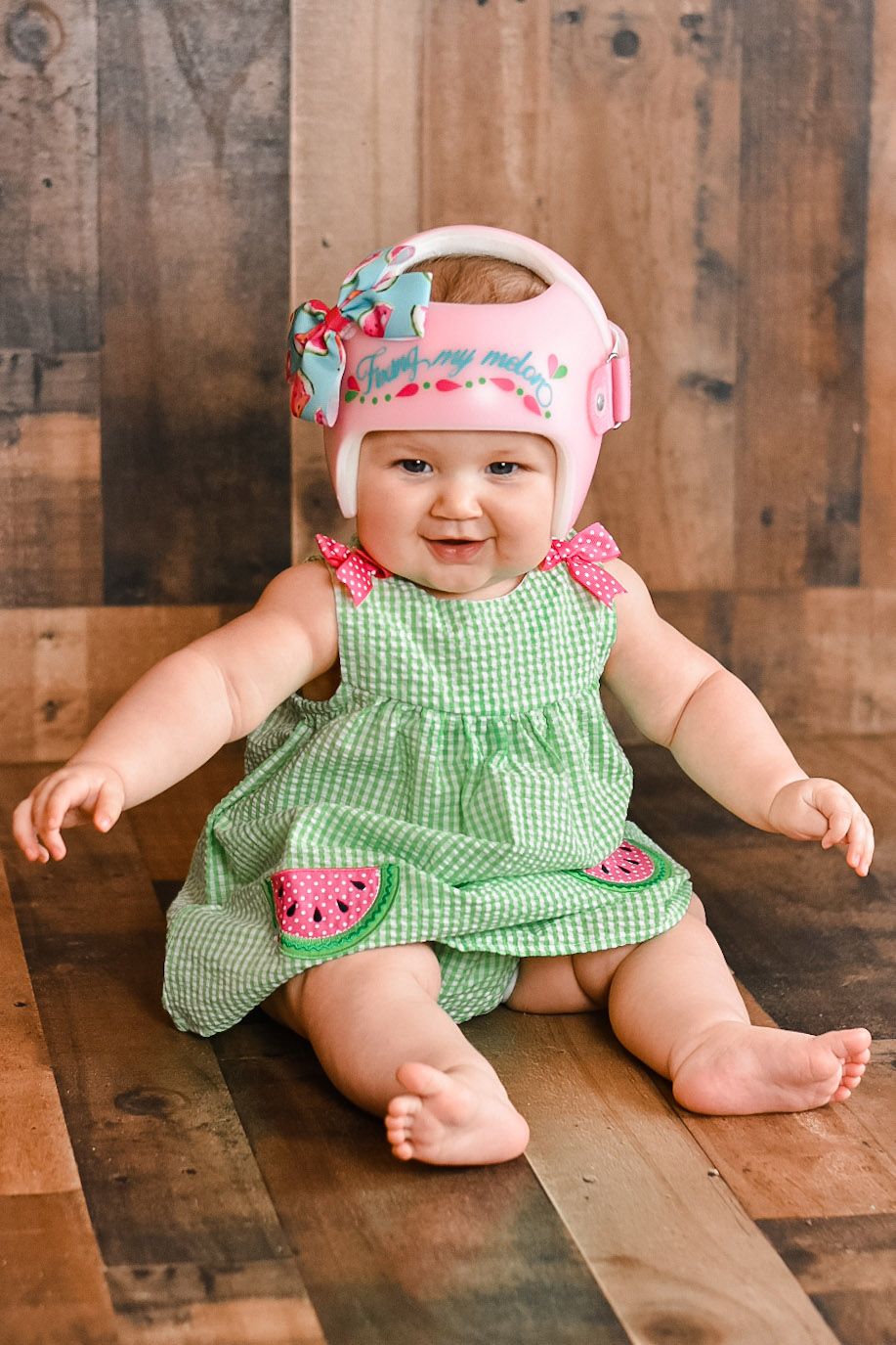 baby wearing cranial remolding orthosis and a watermelon themed outfit. Her cranial orthosis reads 'just fixing my melon'.